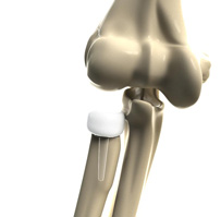 Partial Elbow Replacement Images