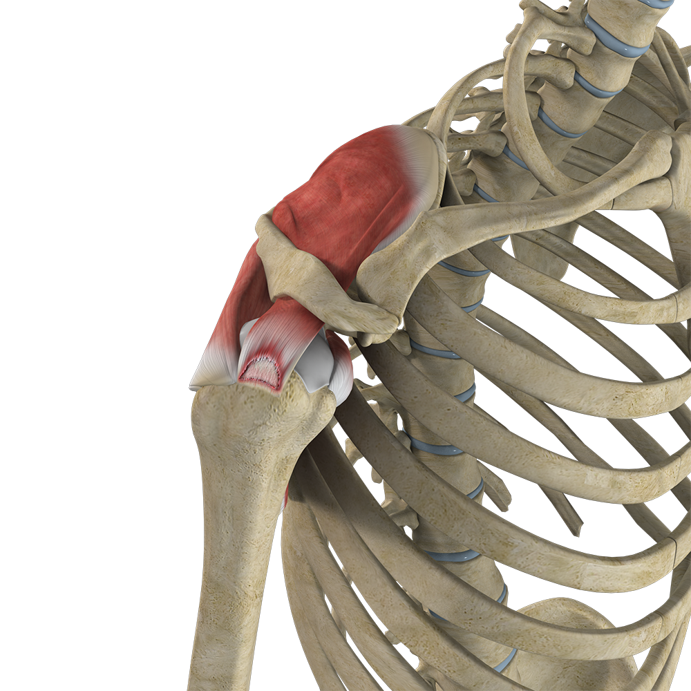Partial Rotator Cuff Tear Images