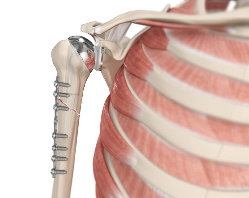 Periprosthetic Shoulder Fracture Fixation Images