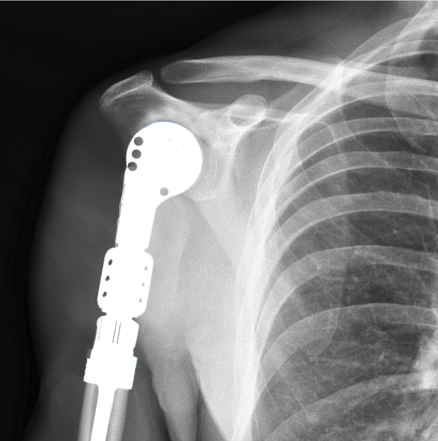 Proximal Humerus Resection and Reconstruction Images