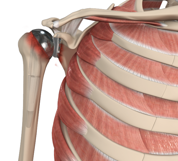 Revision Shoulder Replacement Images