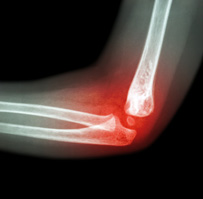 Rheumatoid Elbow Images