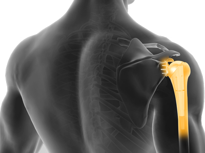 Robotic Assisted Shoulder Replacement  Images