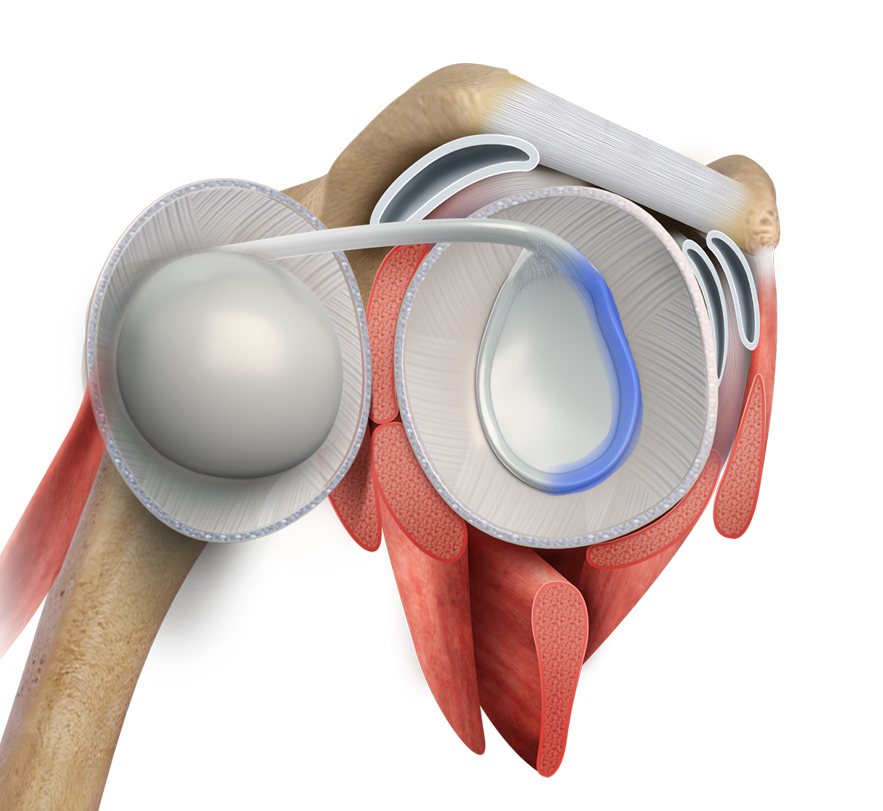 Shoulder Anterior Labral Repair Images