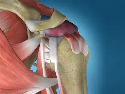 Shoulder Impingement Images