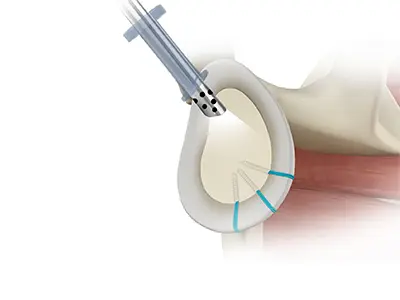 Shoulder Reconstruction Surgery Images