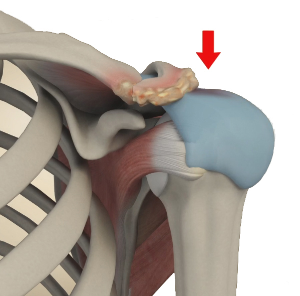 Subacromial Impingement Syndrome Images