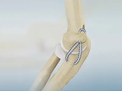 UCL Reconstruction (Tommy John Surgery) Images