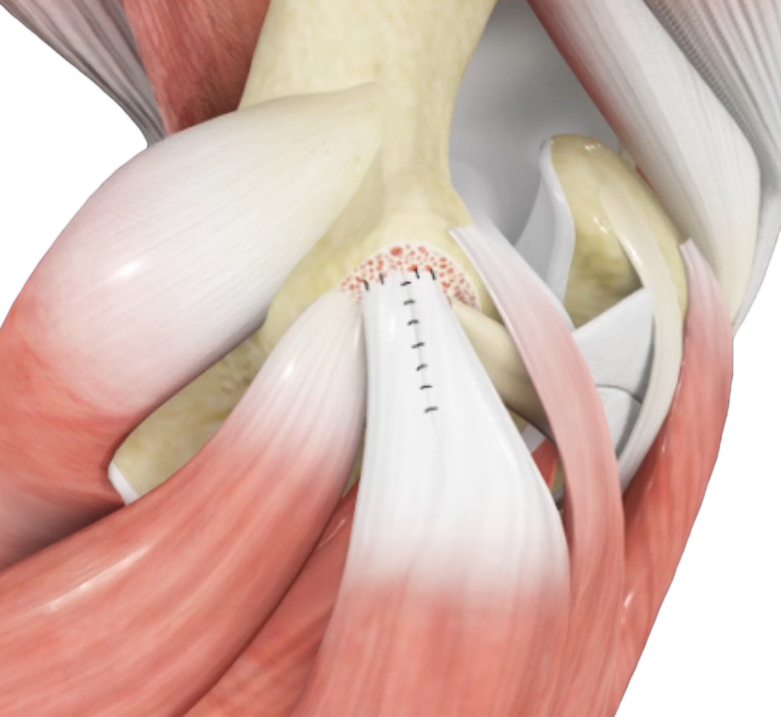 Elbow Flexor Tendon Tear Repair Images