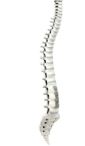 Anterior Lumbar Interbody Fusion
