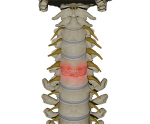 Cervical Degenerative Disc Disease