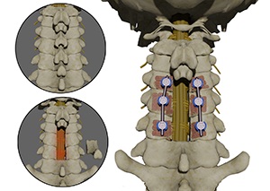 Posterior Cervical Decompression
