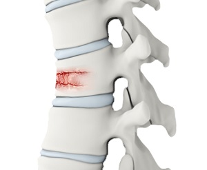 Spine Trauma Surgery
