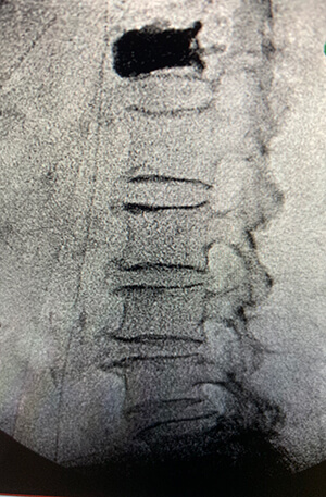 Thoracic Kyphoplasty