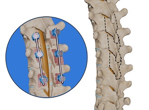 Thoracic Laminectomy