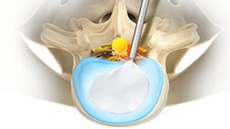 Endoscopic Spine Surgery - image
