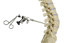 Endoscopic Spine Surgery - image 2