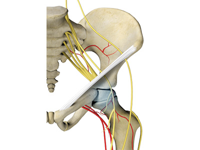 Avascular Necrosis - Educational Picture