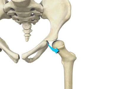 Borderline Hip Dysplasia - Educational Picture