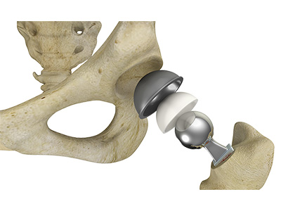 Complex Primary Hip Replacement - Educational Picture