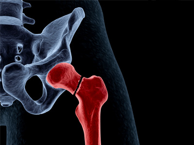 Femoral Neck Fracture - Educational Picture