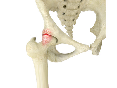 Femoroacetabular Impingement - Educational Picture
