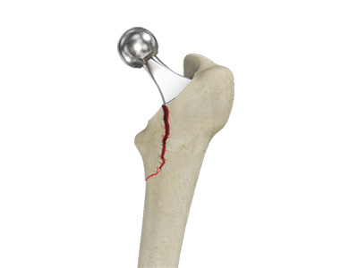 Femur Fracture - Educational Picture