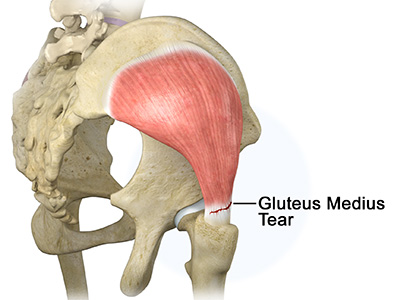 Gluteus Medius Tear - Educational Picture