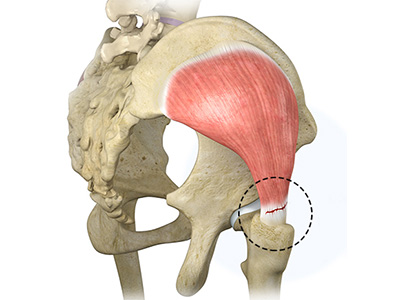 Gluteus Tendon Tear - Educational Picture