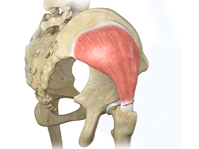 Hip Abductor Tears - Educational Picture