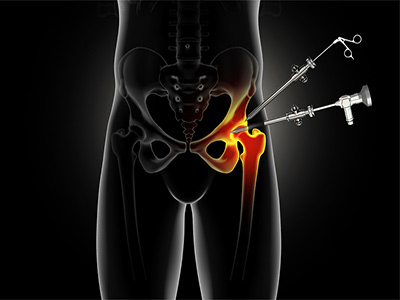 Hip Arthroscopy - Educational Picture