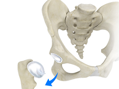 Hip Dislocation - Educational Picture