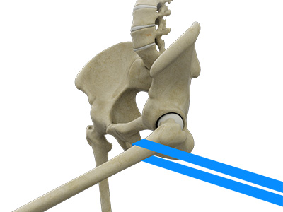 Hip Distraction - Educational Picture