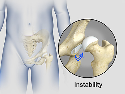 Hip Instability - Educational Picture