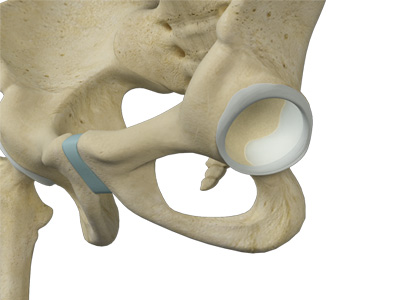 Hip Labral Augmentation - Educational Picture