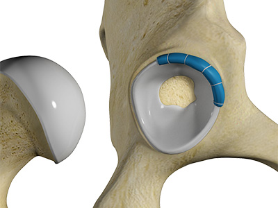 Hip Labral Reconstruction - Educational Picture