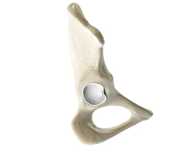 Hip Labral Tear - Educational Picture