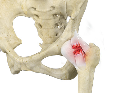 Hip Ligament Injuries - Educational Picture
