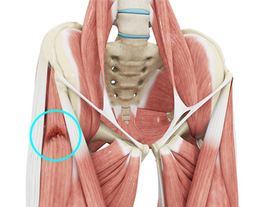 Hip Muscle Strain - Educational Picture