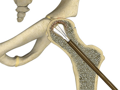 Hip Reconstruction - Educational Picture
