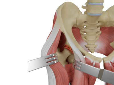 Muscle Sparing Anterior Hip Replacement - Educational Picture