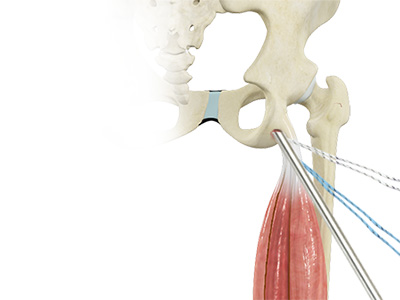 Proximal Hamstring Repair - Educational Picture