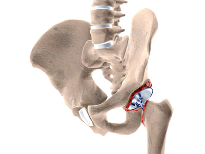 Revision Hip Surgery - Educational Picture