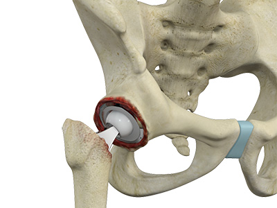 Revision Hip Replacement - Educational Picture