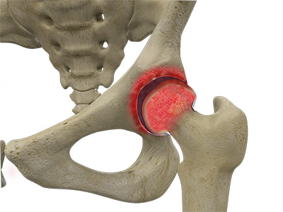 Rheumatoid Arthritis - Educational Picture