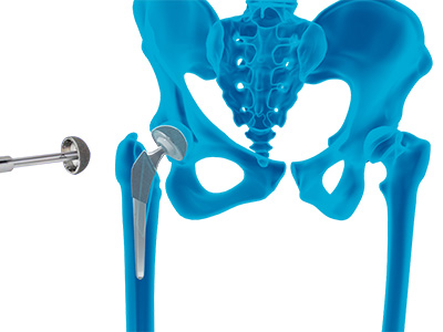 Robotic Total Hip Replacement - Educational Picture