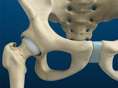 Stress Fractures of the Hip - Educational Picture