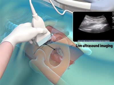 Ultrasound Guided Hip Injections - Educational Picture