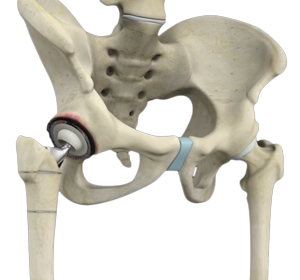 Revision Total Hip Arthroplasty