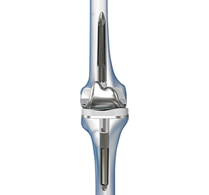 Revision Total Knee Arthroplasty